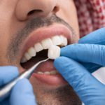 تركيبات الاسنان