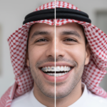 التقويم المعدني والشفاف