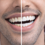 تبييض الاسنان وتجميلها