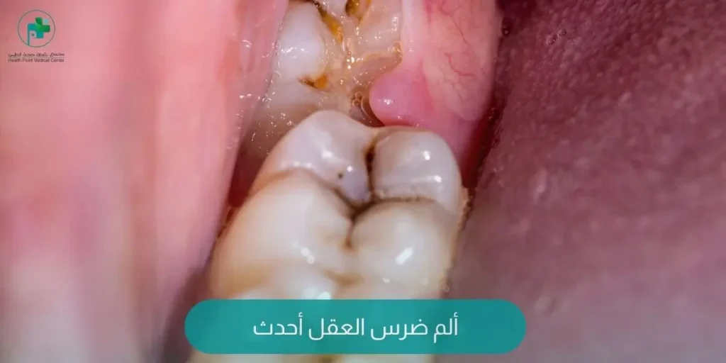 ألم ضرس العقل