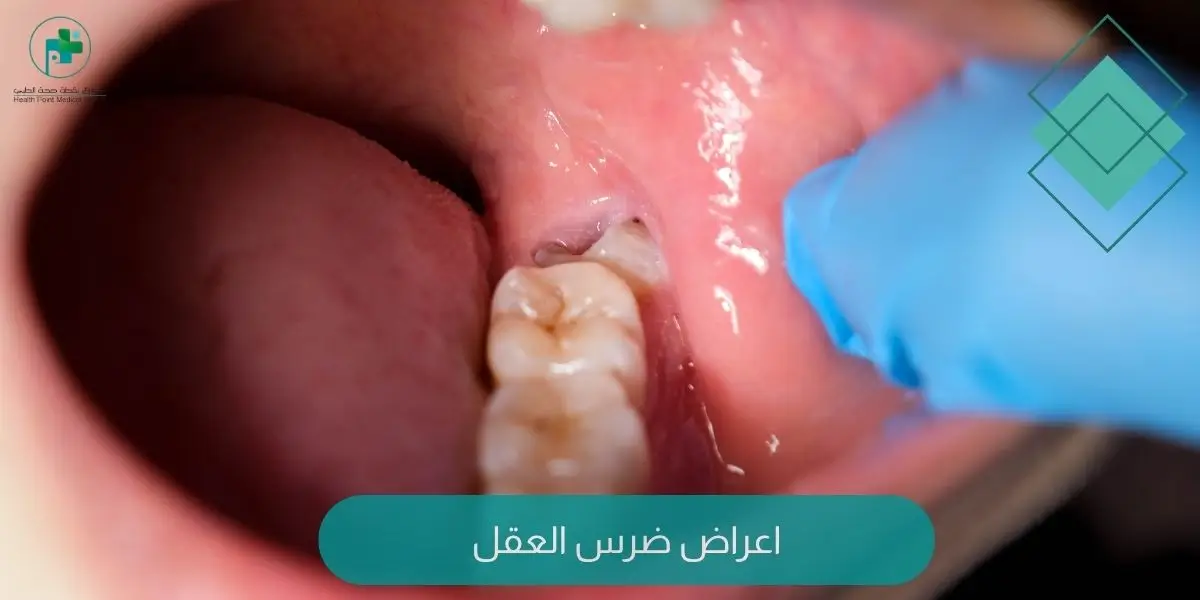 اعراض ضرس العقل