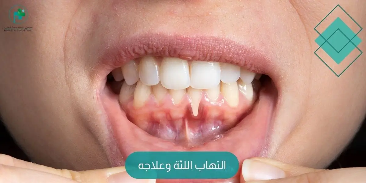 التهاب اللثة وعلاجه