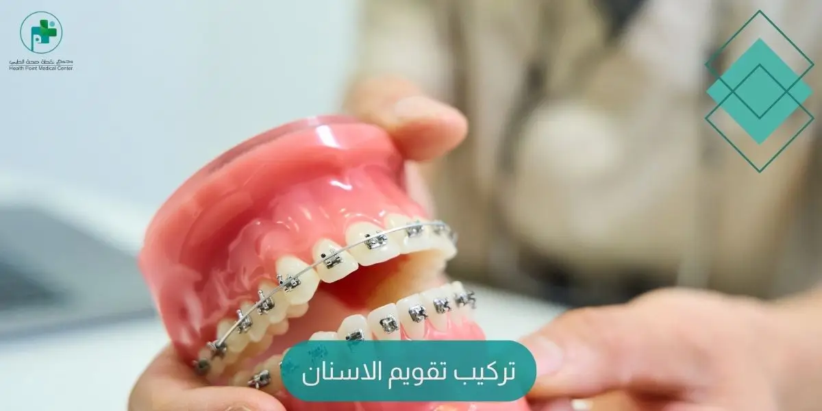 تركيب تقويم الاسنان
