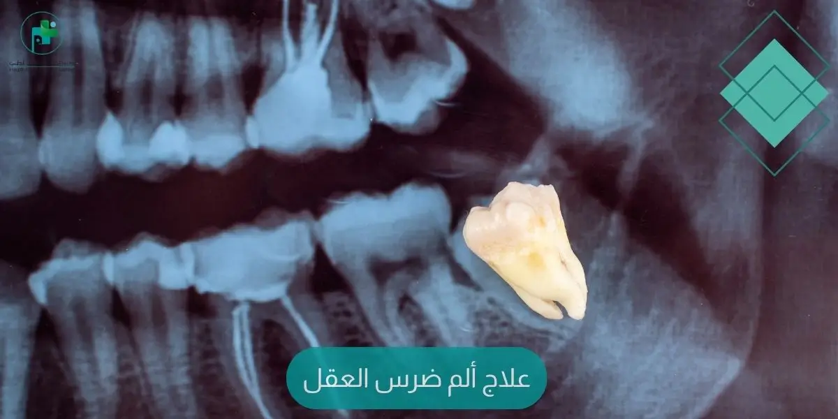 علاج ألم ضرس العقل