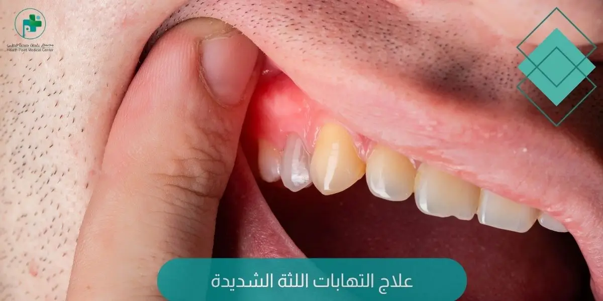 علاج التهابات اللثة الشديدة