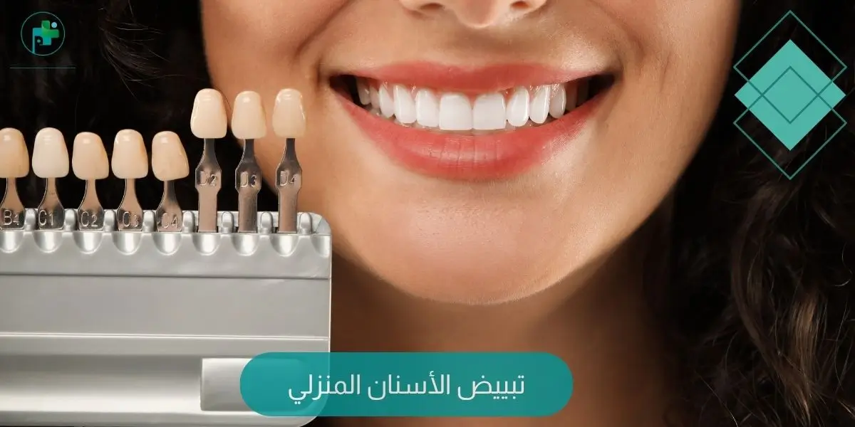 تبييض الأسنان المنزلي