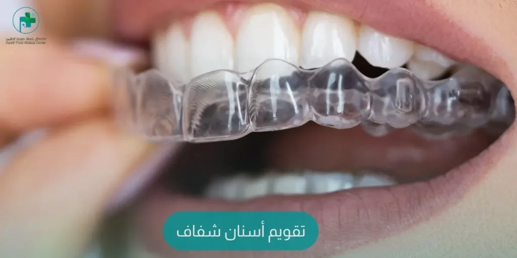 تقويم أسنان شفاف