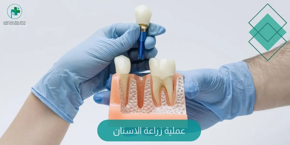 عملية زراعة الاسنان