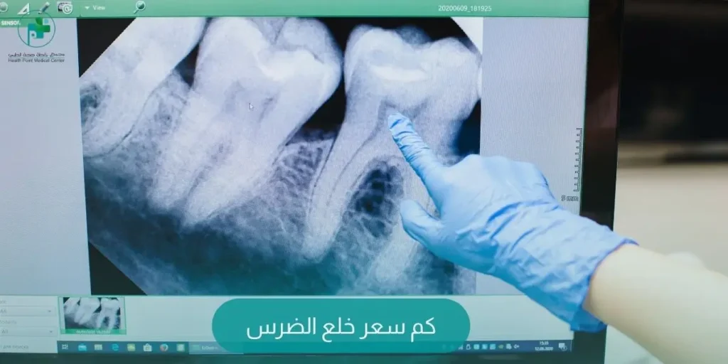 كم سعر خلع الضرس